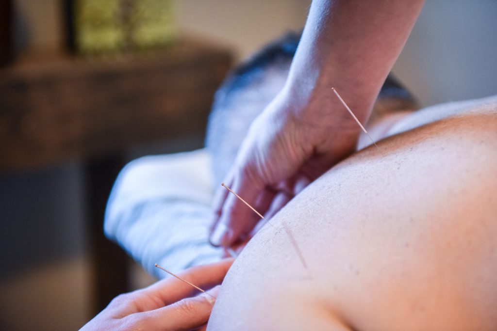 Acupuncture (TCM) | Serenity Now Wellness Center | Integrated Physical & Mental Wellness Centre | Calgary