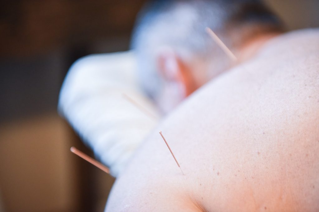 Acupuncture (TCM) | Serenity Now Wellness Center | Integrated Physical & Mental Wellness Centre | Calgary