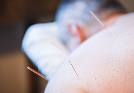 Acupuncture (TCM) | Serenity Now Wellness Center | Integrated Physical & Mental Wellness Centre | Calgary